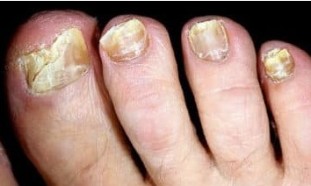 O risco de onychomycosis