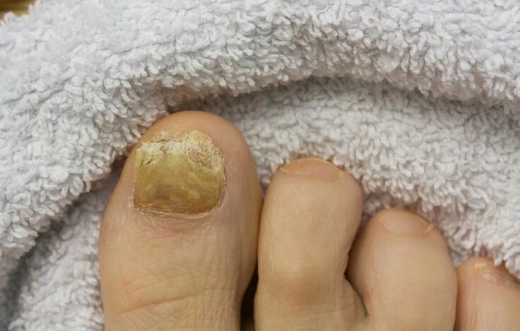 Fungo das uñas