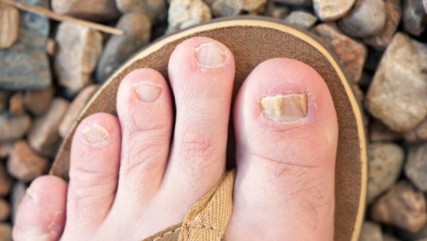 Onicomicosis das uñas